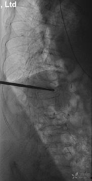 经皮椎体成形术视频