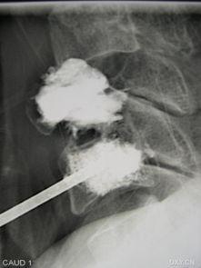 经皮椎体成形术视频